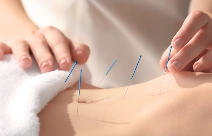 acupuncture